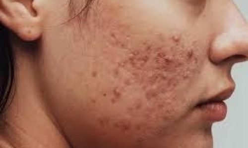 pimple